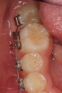 大臼歯の近心傾斜の治療―――――中央区の月島矯正歯科