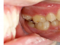 第2大臼歯の傾斜