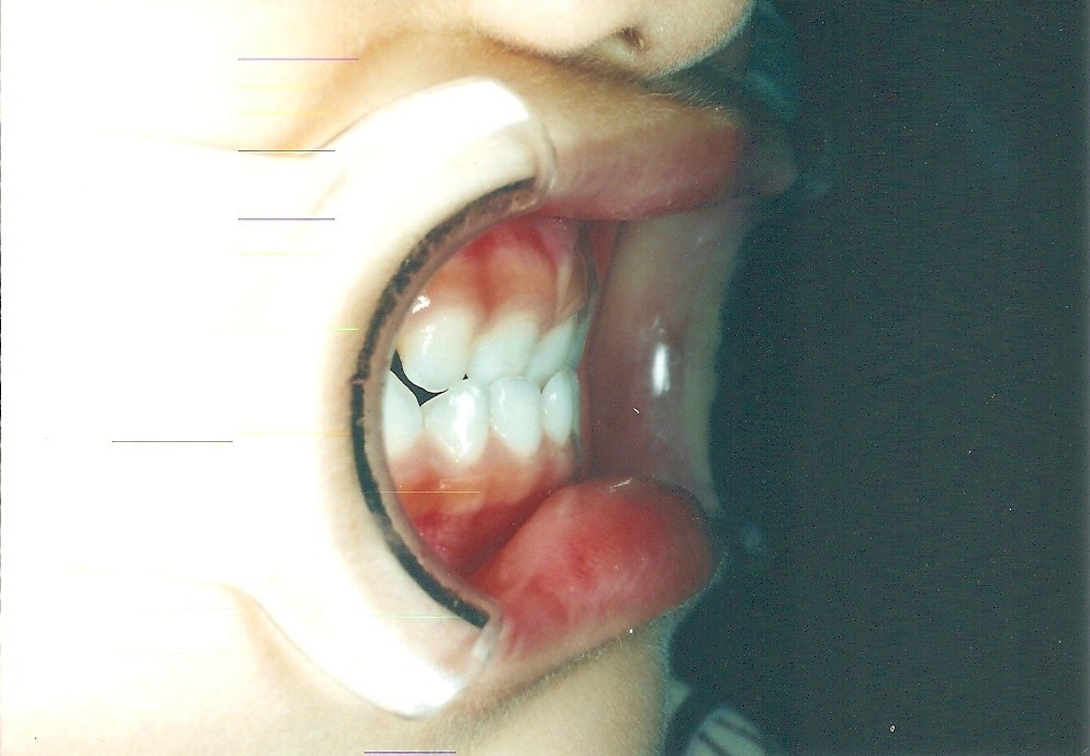 乳歯列期