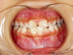 前歯部交換期