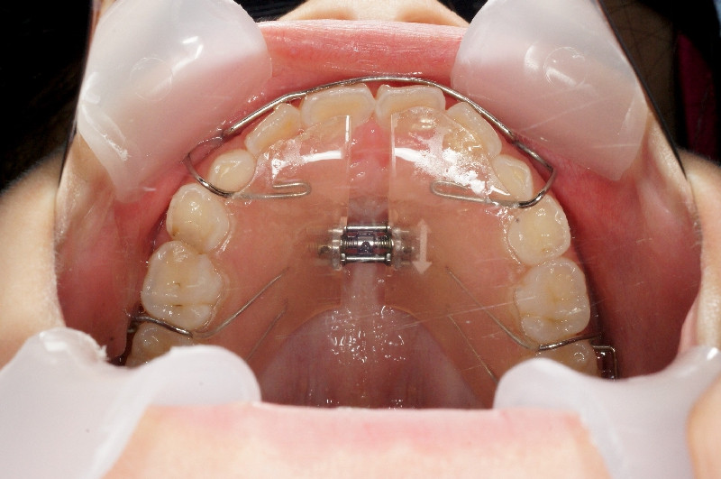 歯列の拡大