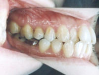 第一大臼歯がクラウンになっています